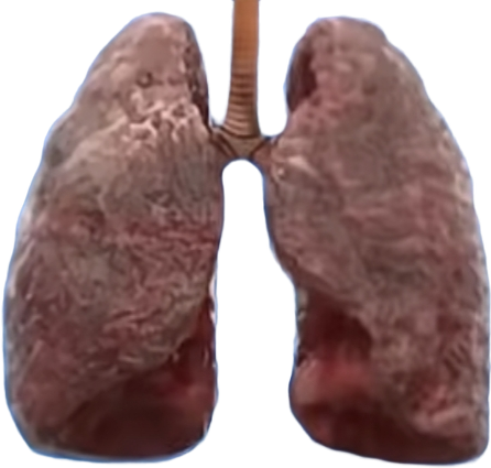 吸烟肺