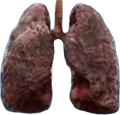 严重吸烟肺